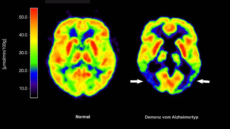 EU-Kommission lässt neuartige Alzheimer-Therapie zu