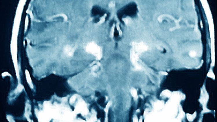 &Auml;rzte warnen vor Schadstoffen im Gehirn